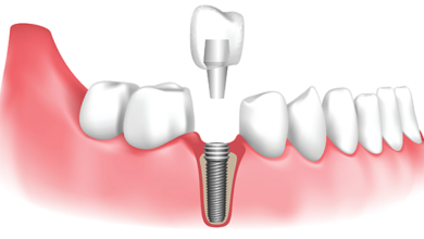 Dental Implants Hungary Helvetic Clinics