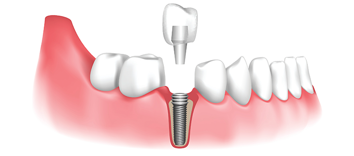 Dental Implants Hungary Helvetic Clinics